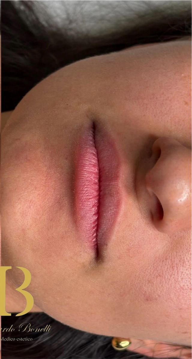 Filler labbra: prima e dopo — dopo