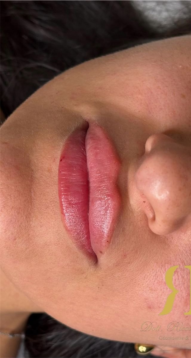 Filler labbra: prima e dopo — prima