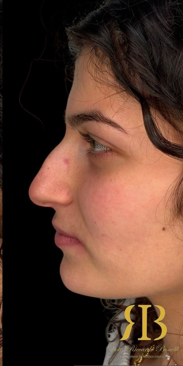 Rinofiller: prima e dopo — dopo