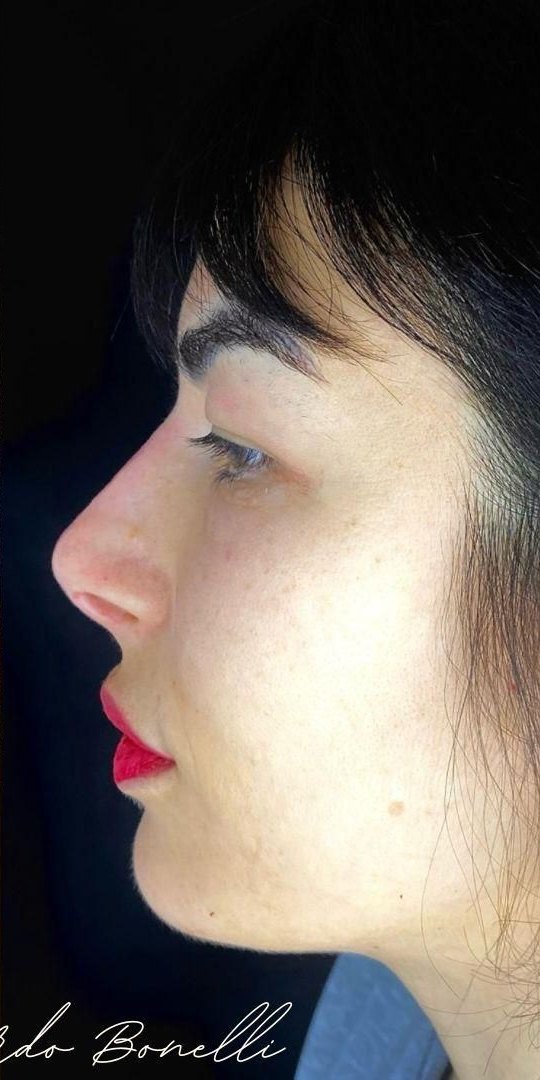 Profilo nasale: risultato naturale — dopo