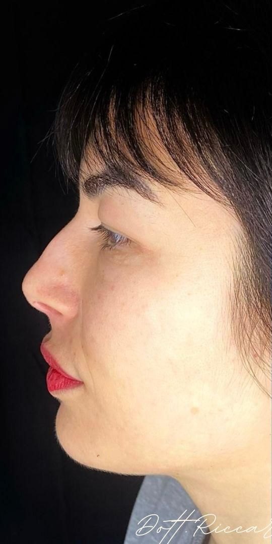Profilo nasale: risultato naturale — prima
