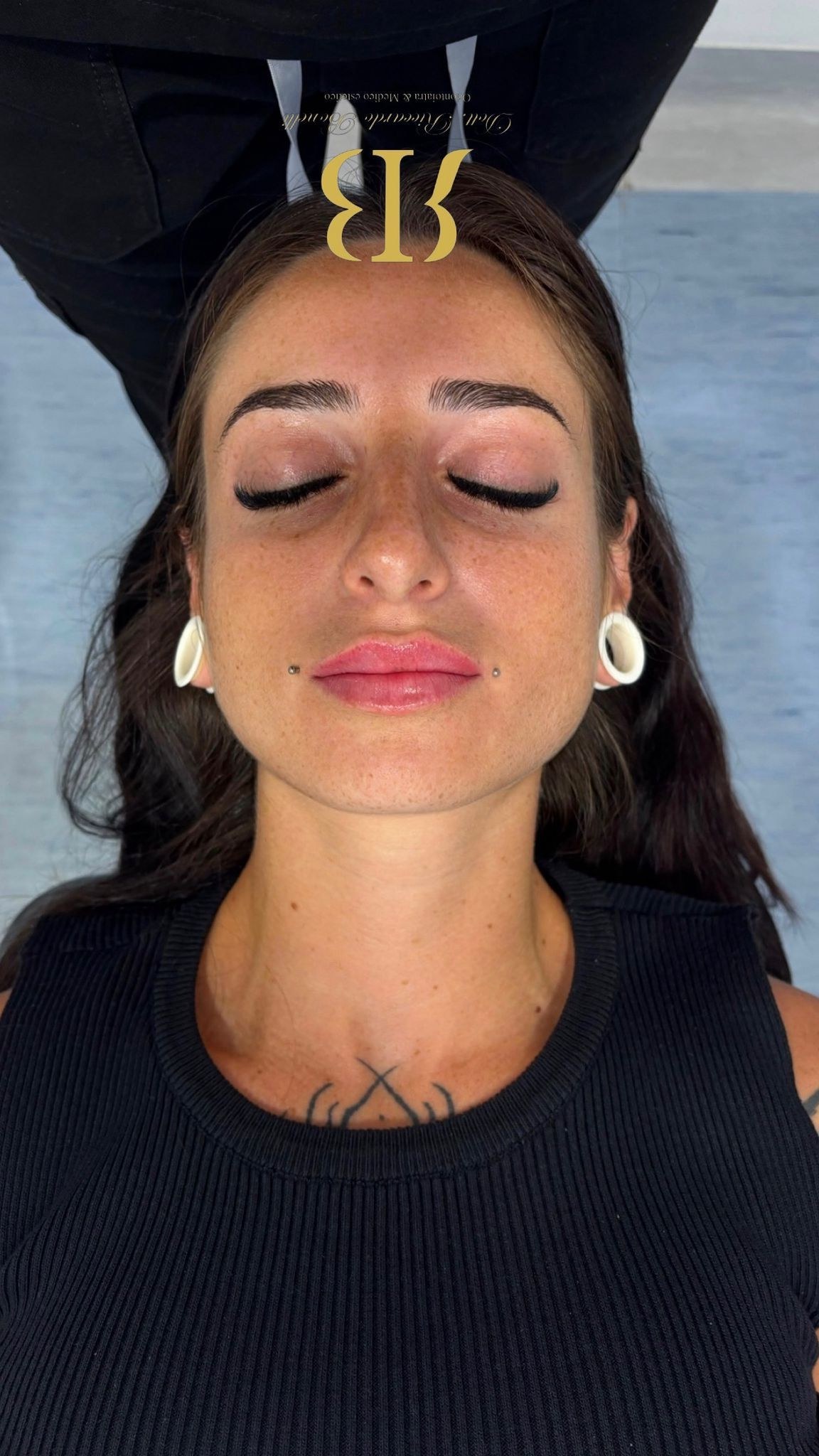 Filler labbra su misura